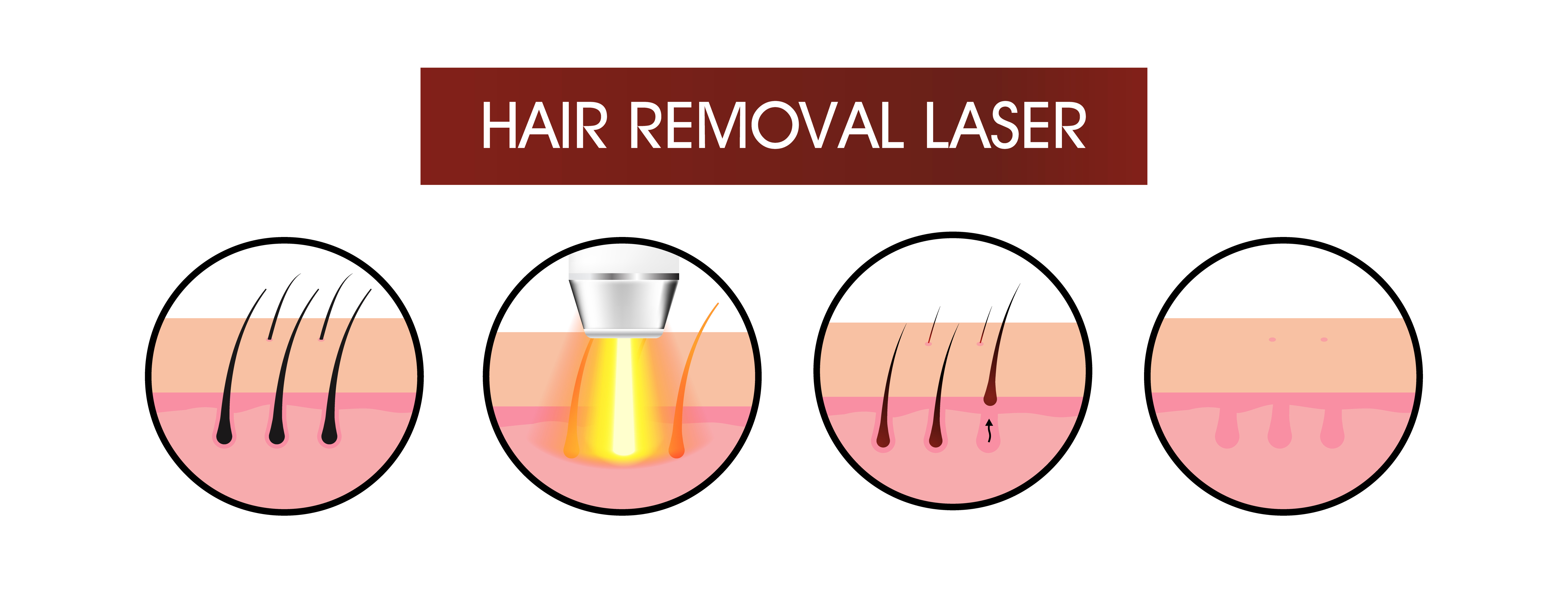 Laser hair removal illustration. OVO Medi Spa.