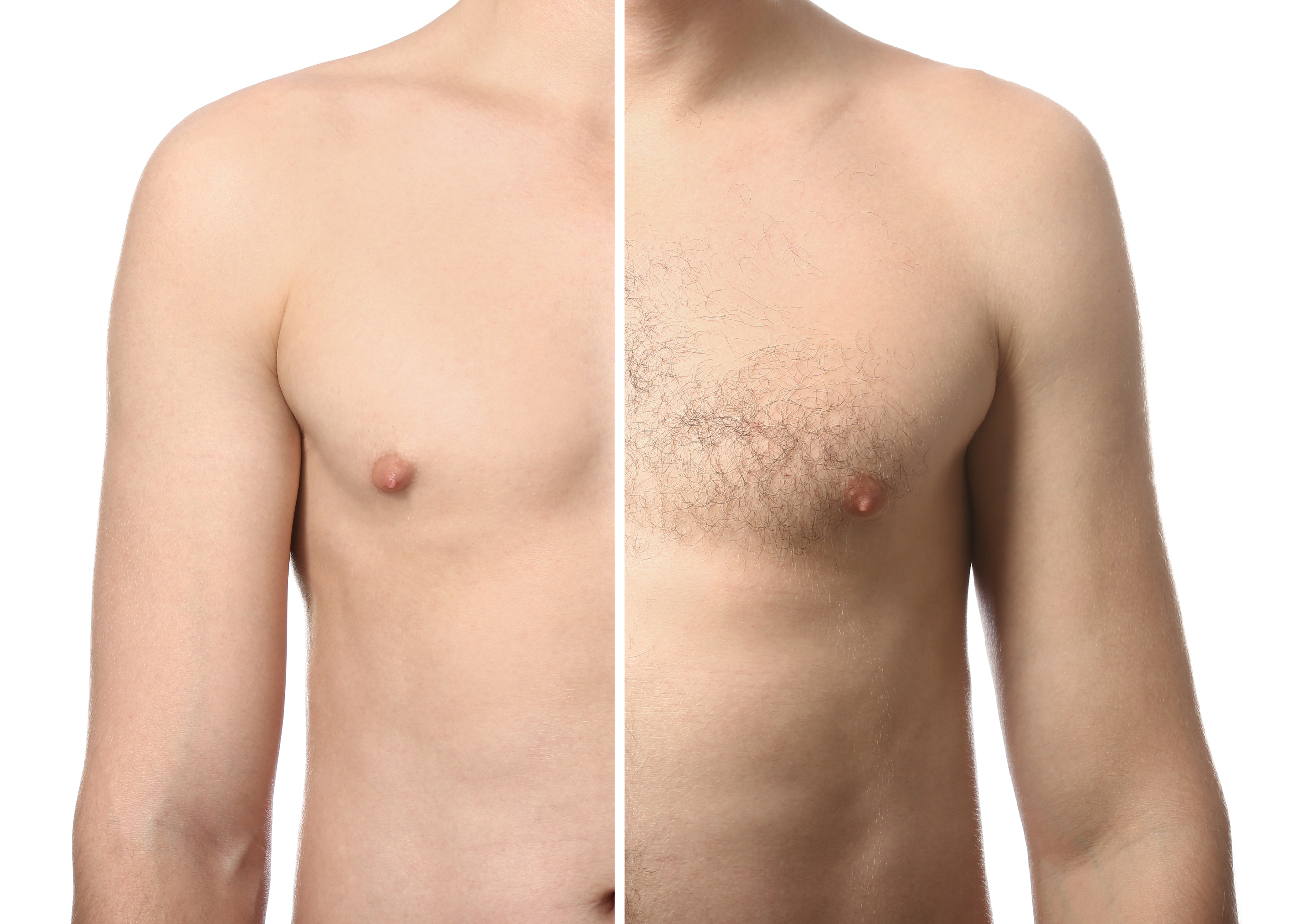 Young man before and after of laser hair removal. OVO Medi Spa.