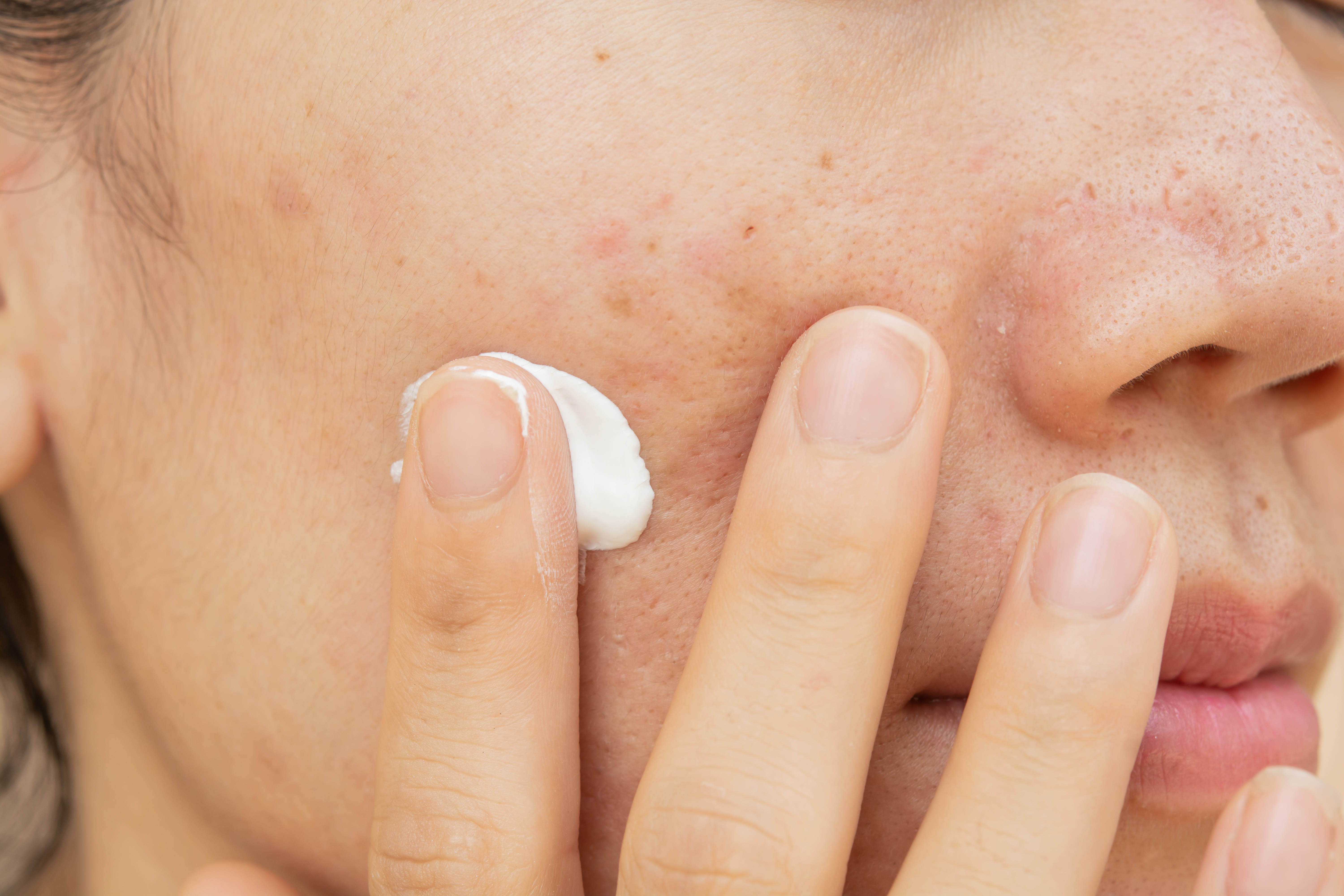 Woman using clinically proven acne products on acne scars and pores. OVO Medi Spa
