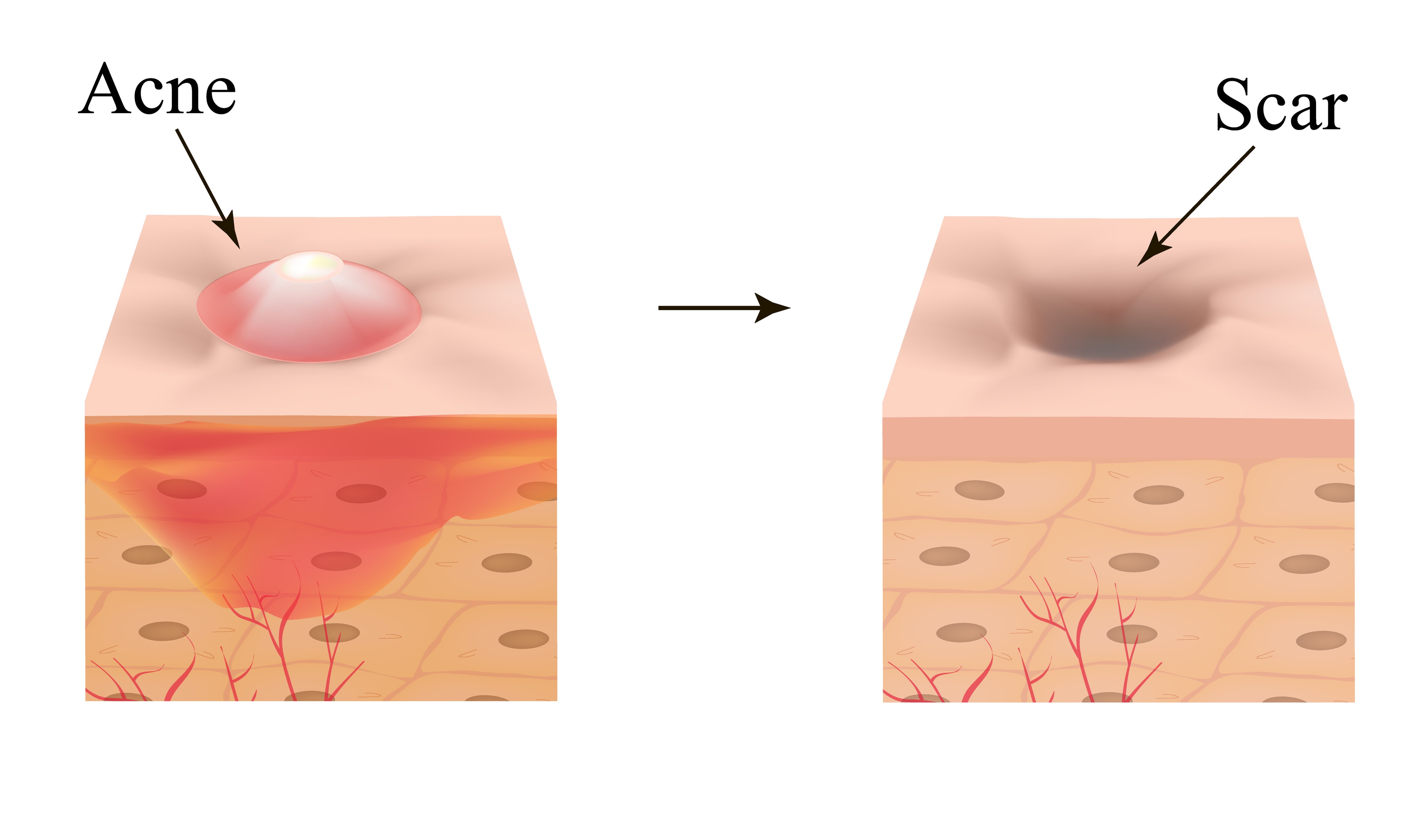 Infographic of inflamed acne and acne scar on the skin. OVO Medi Spa