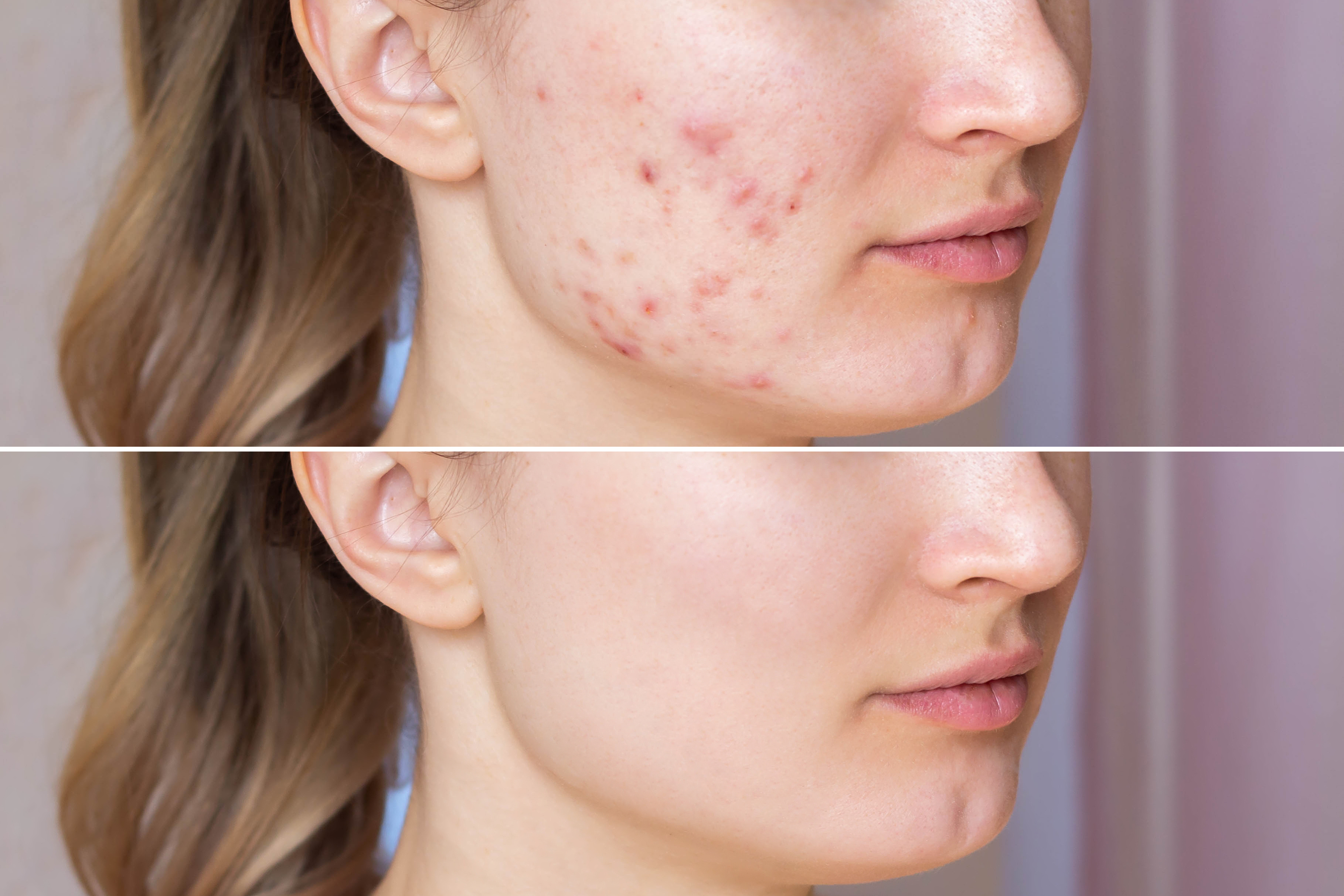 Young woman's face before and after acne treatment for acne scars. OVO Medi Spa.