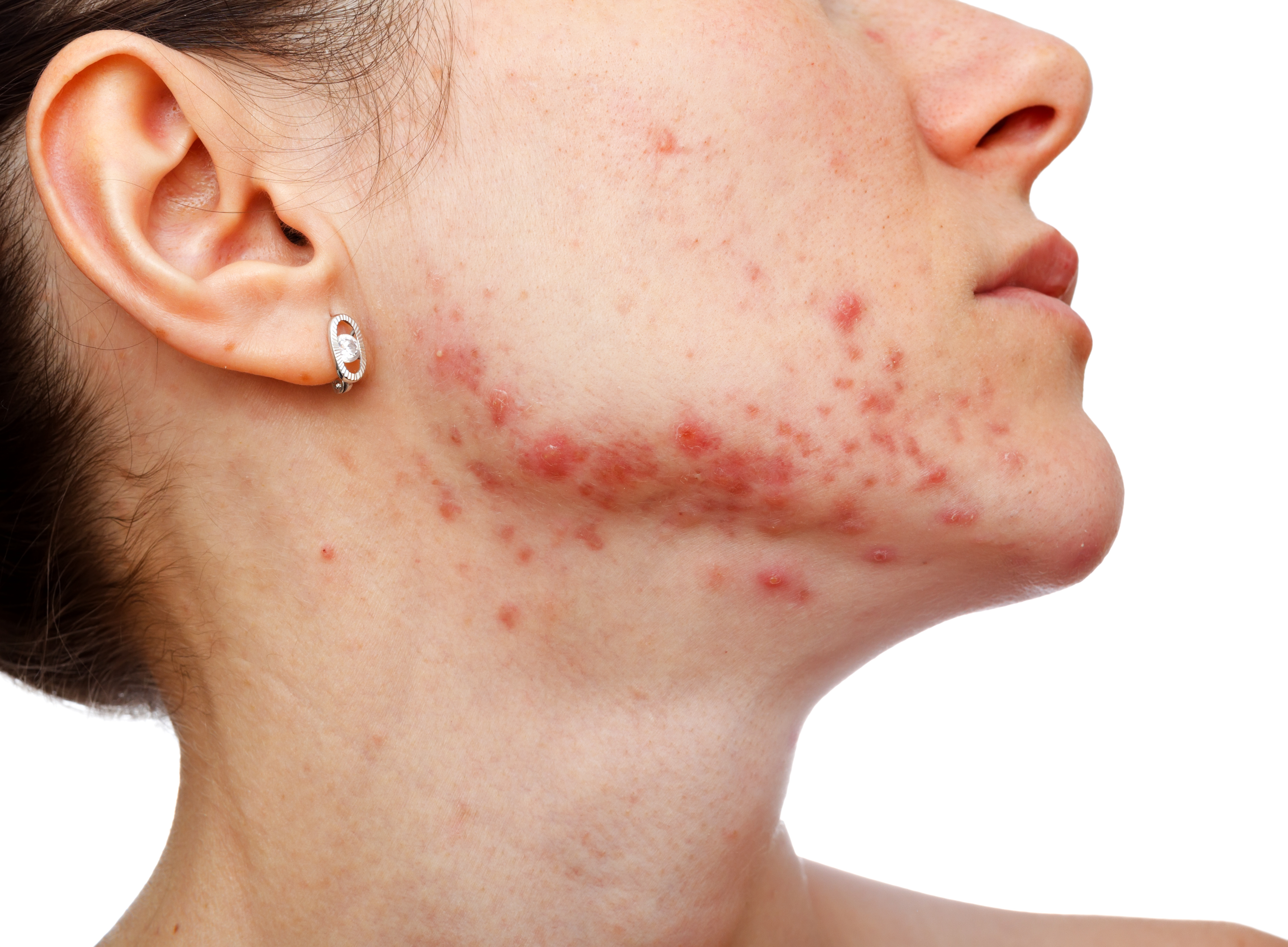 Young woman with inflamed acne blemishes and acne scars on isolated white background. OVO Medi Spa